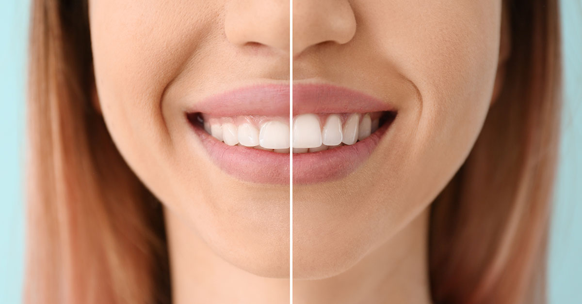 Marco Island Dentist Answers Questions About Gum Contouring