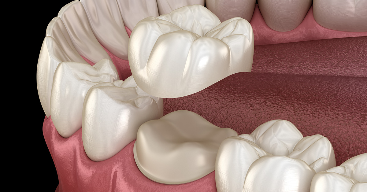 What To Do If Your Dental Crown Falls Off