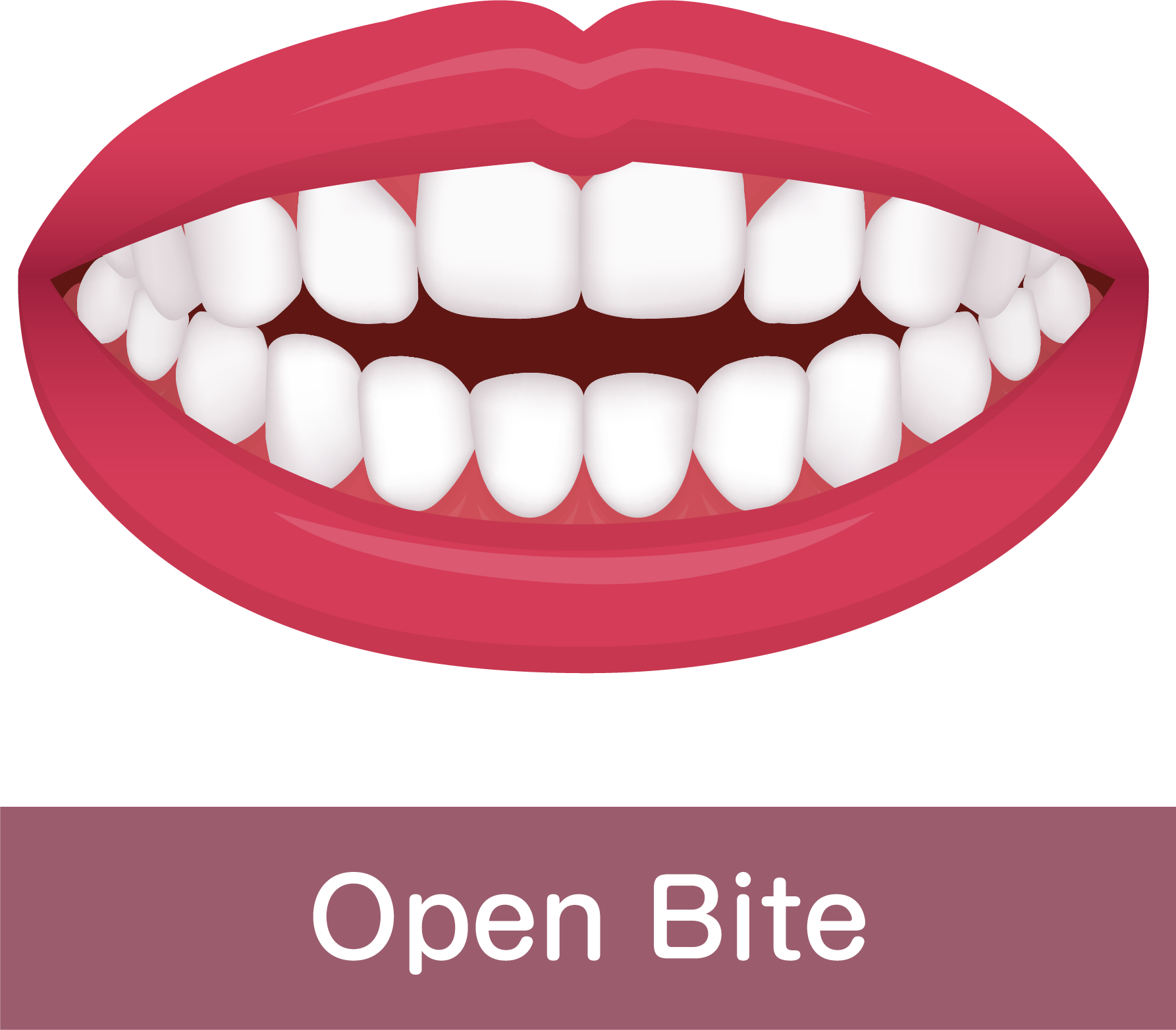 Open Bite Island Tower Dentistry